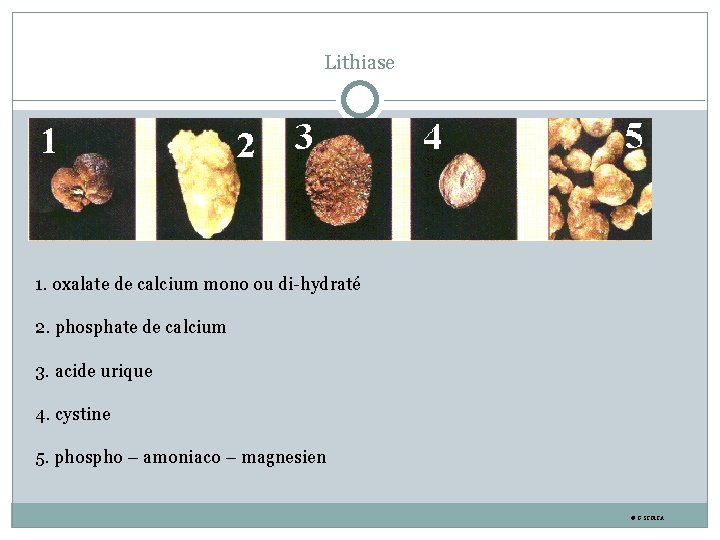 Lithiase 1. oxalate de calcium mono ou di-hydraté 2. phosphate de calcium 3. acide