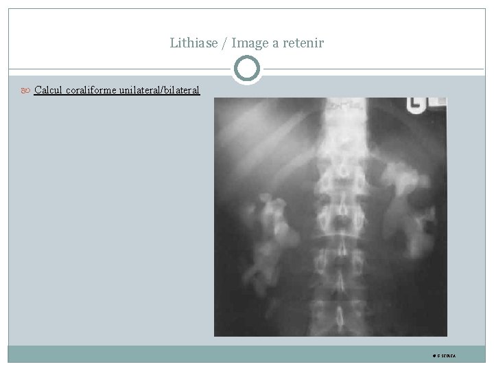 Lithiase / Image a retenir Calcul coraliforme unilateral/bilateral © G. STOICA 