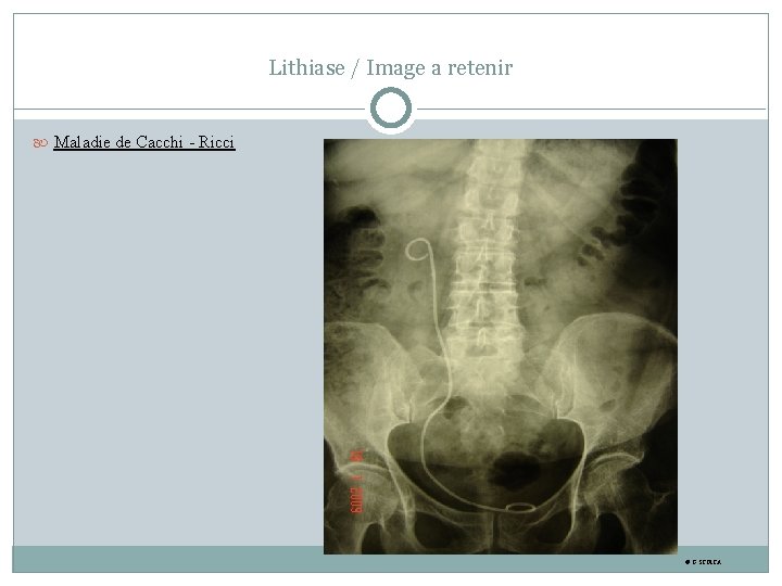 Lithiase / Image a retenir Maladie de Cacchi - Ricci © G. STOICA 