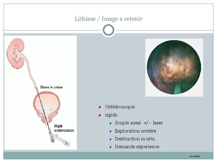 Lithiase / Image a retenir Urétéroscopie rigide Souple aussi +/- laser Exploration uretère Destruction