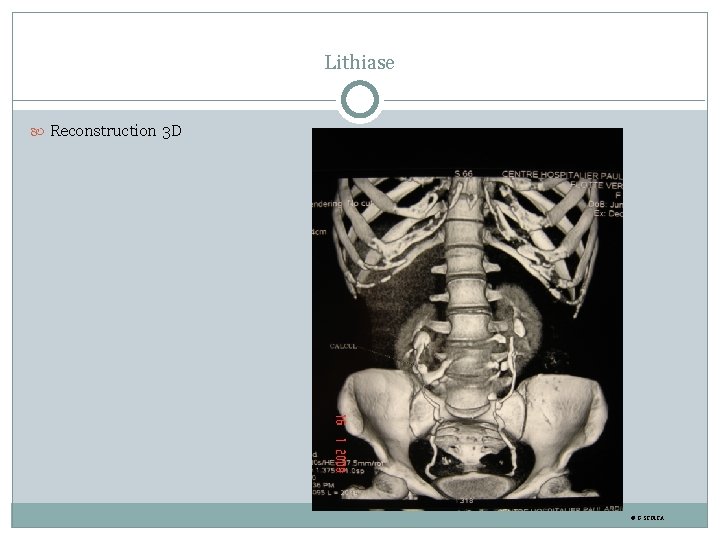 Lithiase Reconstruction 3 D © G. STOICA 