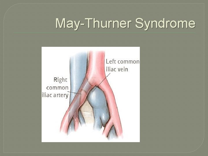 May-Thurner Syndrome 