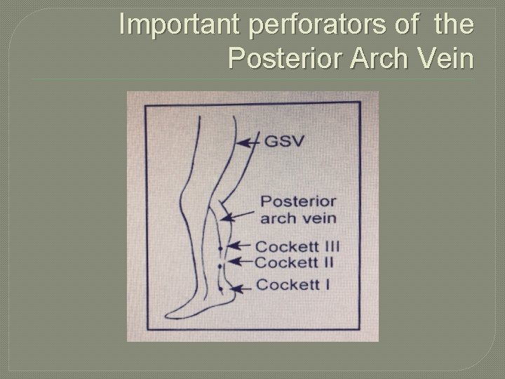 Important perforators of the Posterior Arch Vein 