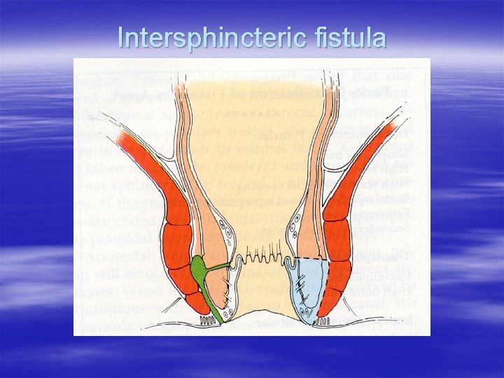 Intersphincteric fistula 