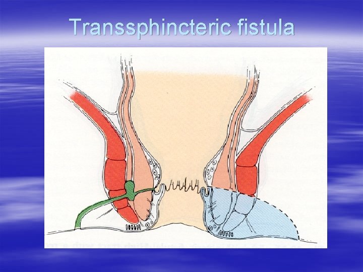 Transsphincteric fistula 