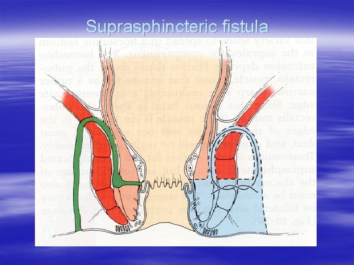Suprasphincteric fistula 