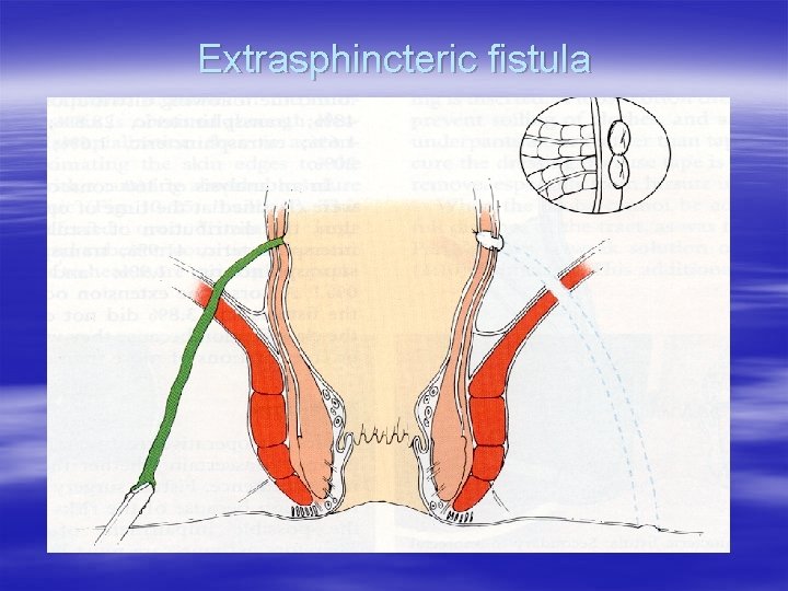 Extrasphincteric fistula 