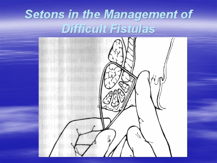 Setons in the Management of Difficult Fistulas 