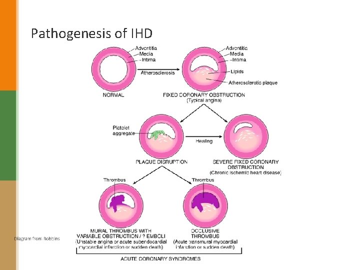 Pathogenesis of IHD 