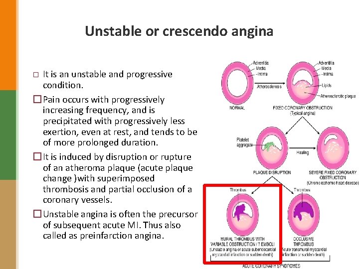 Unstable or crescendo angina It is an unstable and progressive condition. �Pain occurs with