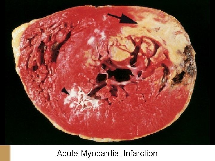 Acute Myocardial Infarction 