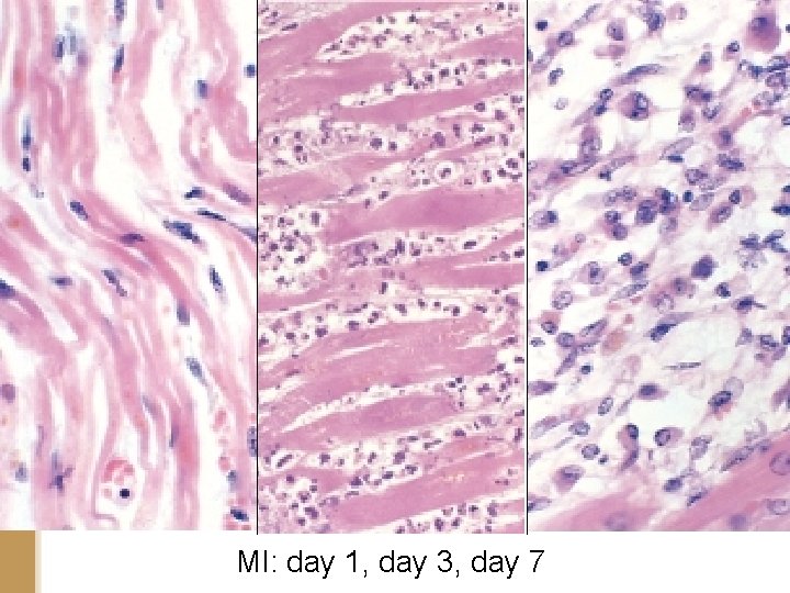 MI: day 1, day 3, day 7 