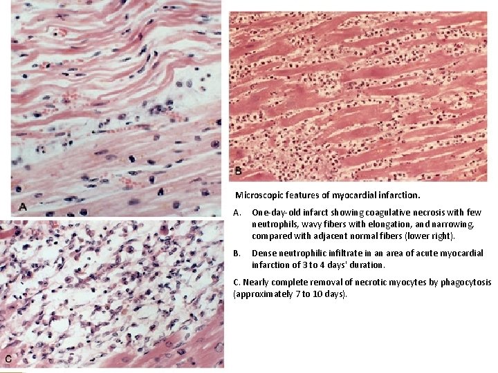 Microscopic features of myocardial infarction. A. One-day-old infarct showing coagulative necrosis with few neutrophils,