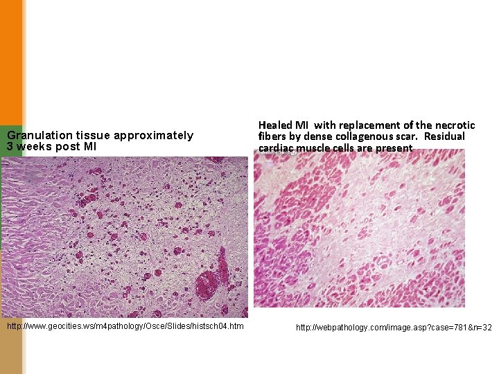 Granulation tissue approximately 3 weeks post MI http: //www. geocities. ws/m 4 pathology/Osce/Slides/histsch 04.