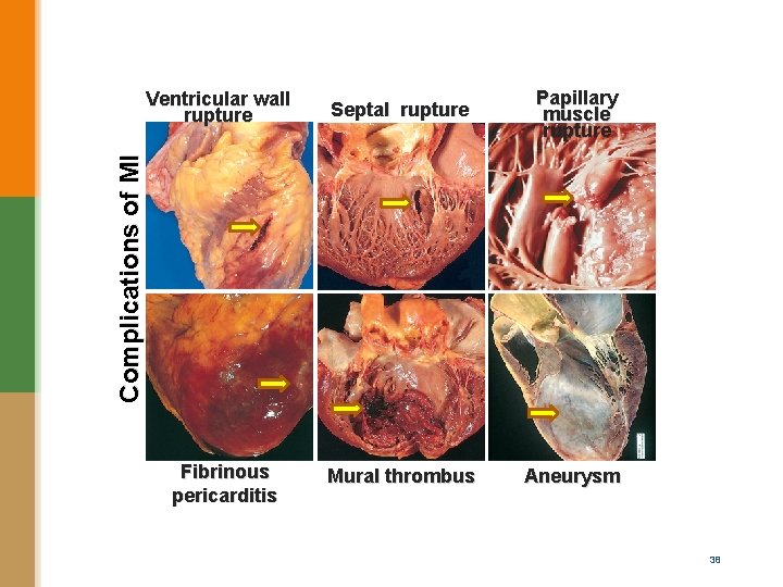 Septal rupture Papillary muscle rupture Mural thrombus Aneurysm Complications of MI Ventricular wall rupture