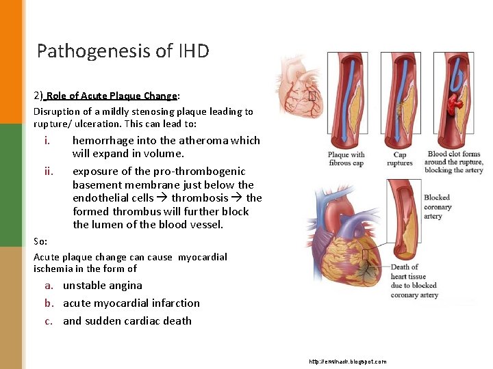 Pathogenesis of IHD 2) Role of Acute Plaque Change: Disruption of a mildly stenosing
