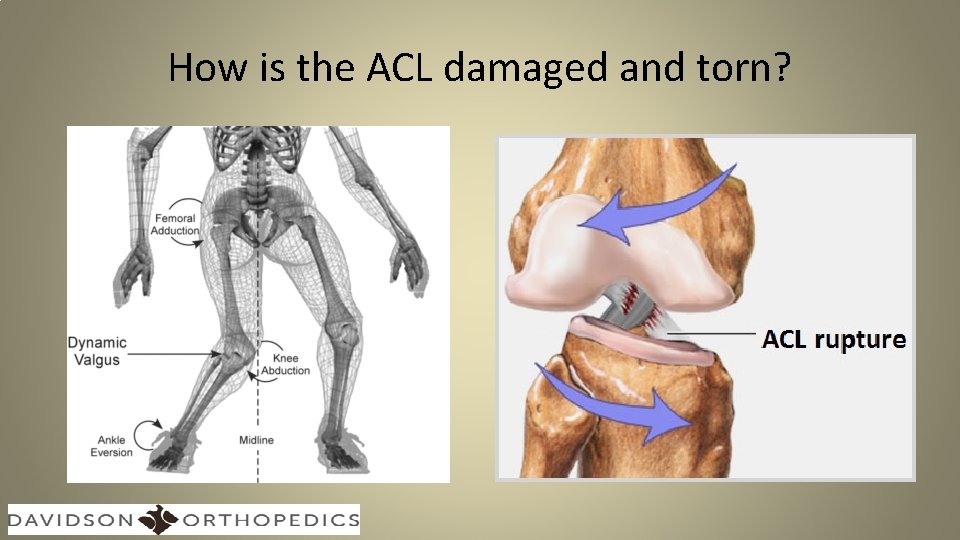 How is the ACL damaged and torn? 
