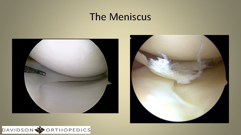 The Meniscus 