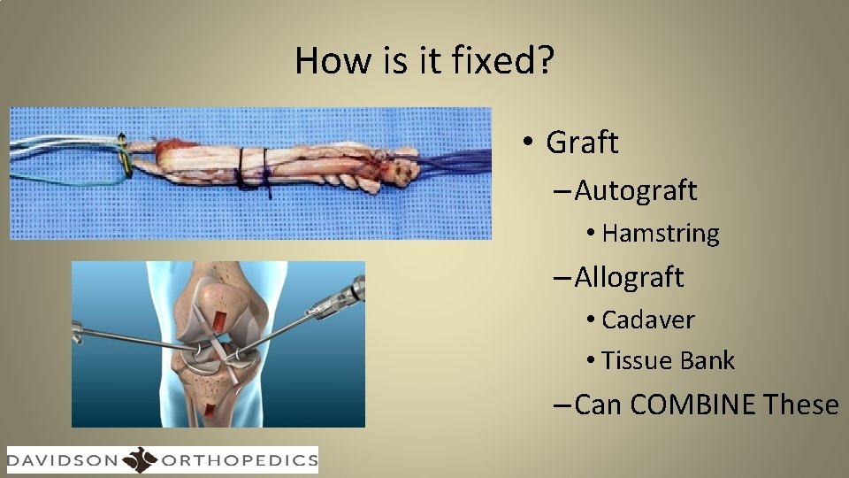 How is it fixed? • Graft – Autograft • Hamstring – Allograft • Cadaver