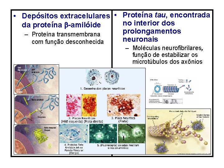  • Depósitos extracelulares • Proteína tau, encontrada no interior dos da proteína -amilóide