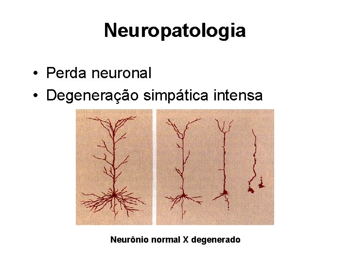 Neuropatologia • Perda neuronal • Degeneração simpática intensa Neurônio normal X degenerado 