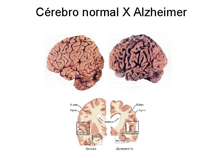 Cérebro normal X Alzheimer 