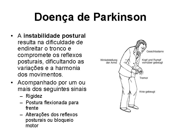 Doença de Parkinson • A instabilidade postural resulta na dificuldade de endireitar o tronco