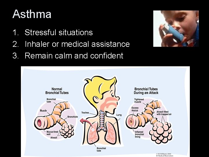 Asthma 1. Stressful situations 2. Inhaler or medical assistance 3. Remain calm and confident