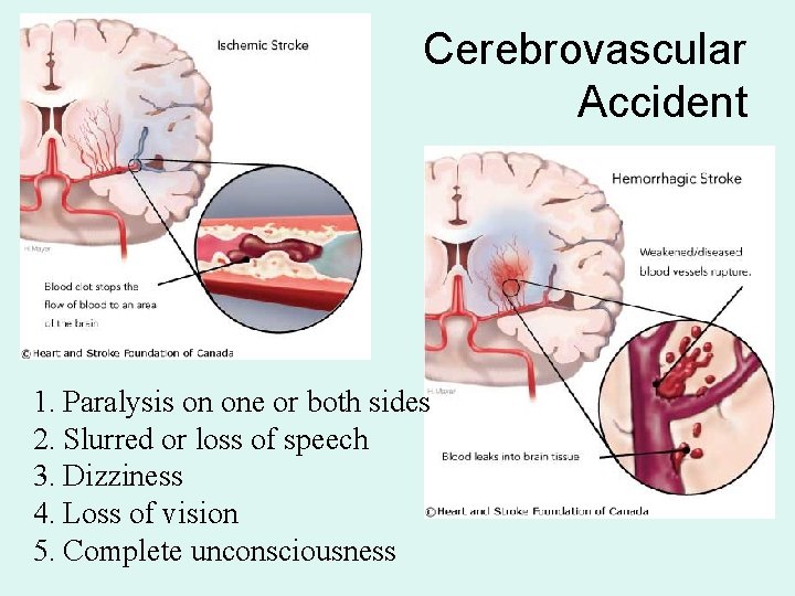 Cerebrovascular Accident 1. Paralysis on one or both sides 2. Slurred or loss of