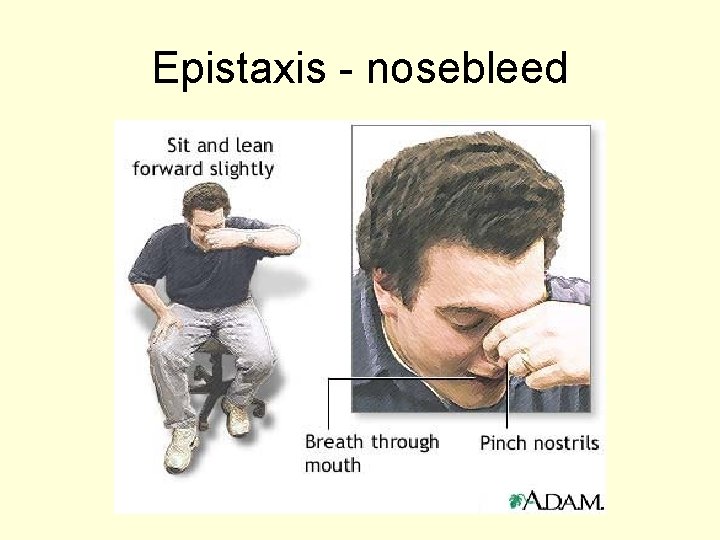 Epistaxis - nosebleed 