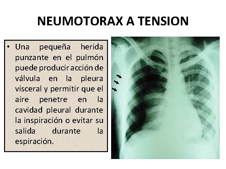 NEUMOTORAX A TENSION • Una pequeña herida punzante en el pulmón puede producir acción