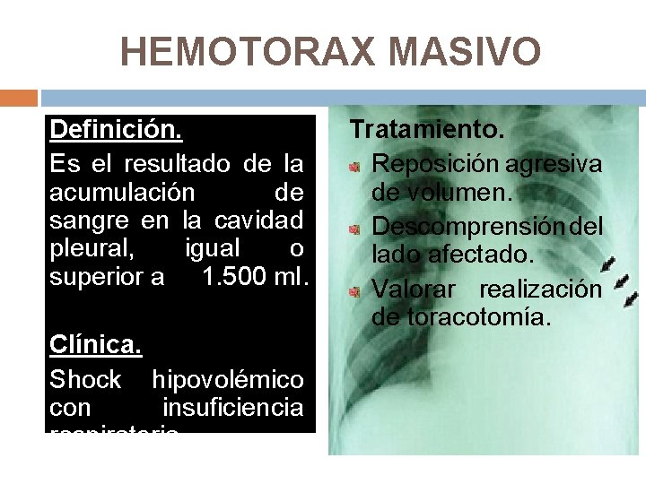 HEMOTORAX MASIVO Definición. Es el resultado de la acumulación de sangre en la cavidad
