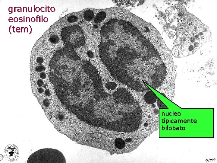 granulocito eosinofilo (tem) nucleo tipicamente bilobato 