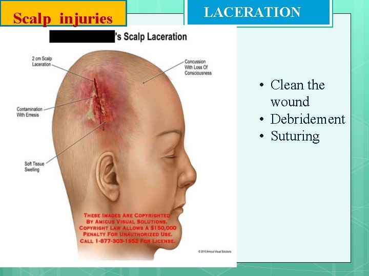 Scalp injuries LACERATION • Clean the wound • Debridement • Suturing 