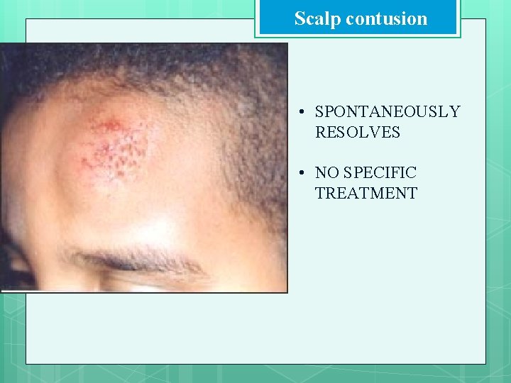 Scalp contusion • SPONTANEOUSLY RESOLVES • NO SPECIFIC TREATMENT 
