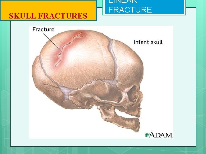 SKULL FRACTURES LINEAR FRACTURE 