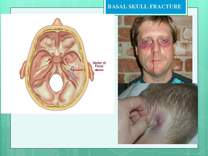 BASAL SKULL FRACTURE 