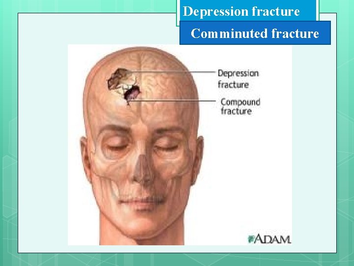 Depression fracture Comminuted fracture 