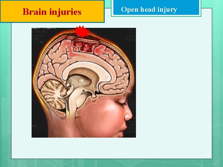 Brain injuries Open head injury 