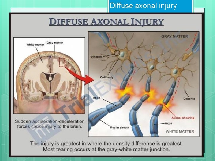 Diffuse axonal injury 