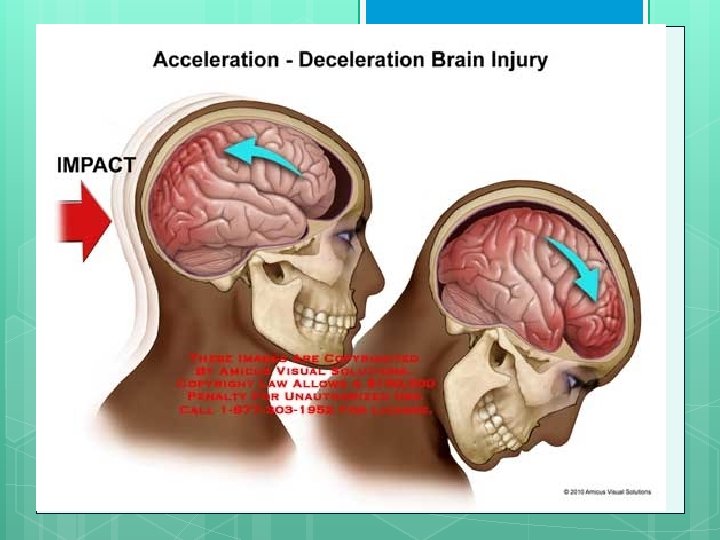  Acceleration Rotational deceleration injuries 