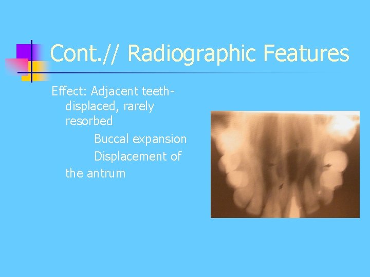 Cont. // Radiographic Features Effect: Adjacent teethdisplaced, rarely resorbed Buccal expansion Displacement of the Cont. // Radiographic Features Effect: Adjacent teethdisplaced, rarely resorbed Buccal expansion Displacement of the