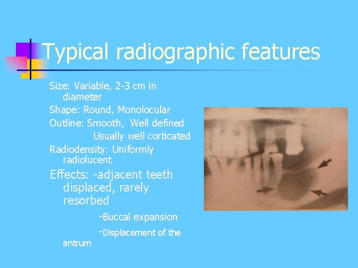 Typical radiographic features Size: Variable, 2 -3 cm in diameter Shape: Round, Monolocular Outline: Typical radiographic features Size: Variable, 2 -3 cm in diameter Shape: Round, Monolocular Outline: