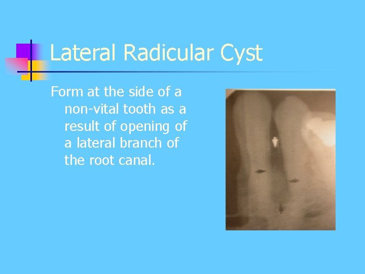 Lateral Radicular Cyst Form at the side of a non-vital tooth as a result Lateral Radicular Cyst Form at the side of a non-vital tooth as a result