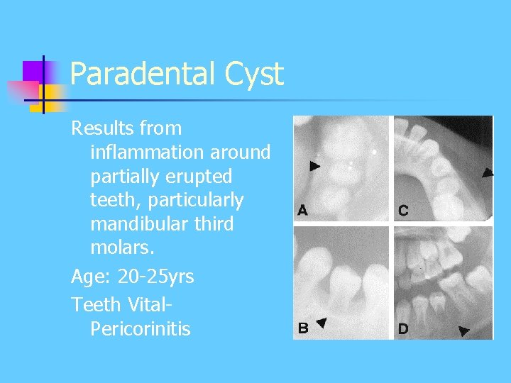 Paradental Cyst Results from inflammation around partially erupted teeth, particularly mandibular third molars. Age: Paradental Cyst Results from inflammation around partially erupted teeth, particularly mandibular third molars. Age: