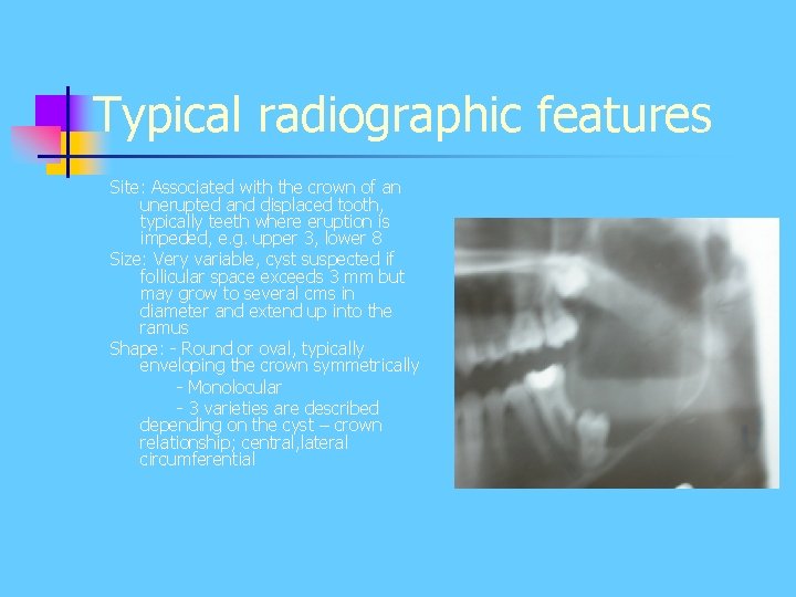 Typical radiographic features Site: Associated with the crown of an unerupted and displaced tooth, Typical radiographic features Site: Associated with the crown of an unerupted and displaced tooth,