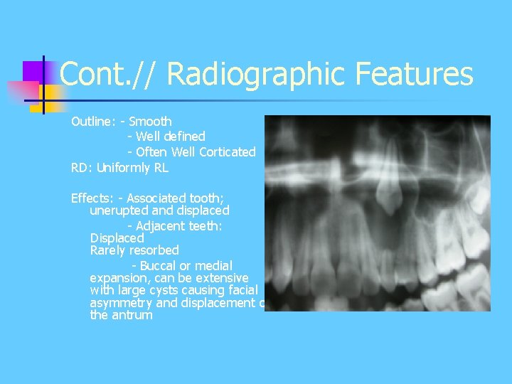 Cont. // Radiographic Features Outline: - Smooth - Well defined - Often Well Corticated Cont. // Radiographic Features Outline: - Smooth - Well defined - Often Well Corticated