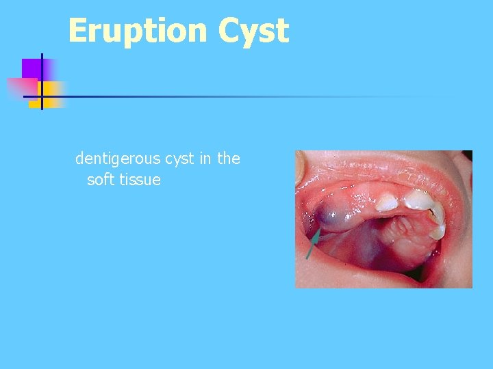 Eruption Cyst dentigerous cyst in the soft tissue Eruption Cyst dentigerous cyst in the soft tissue