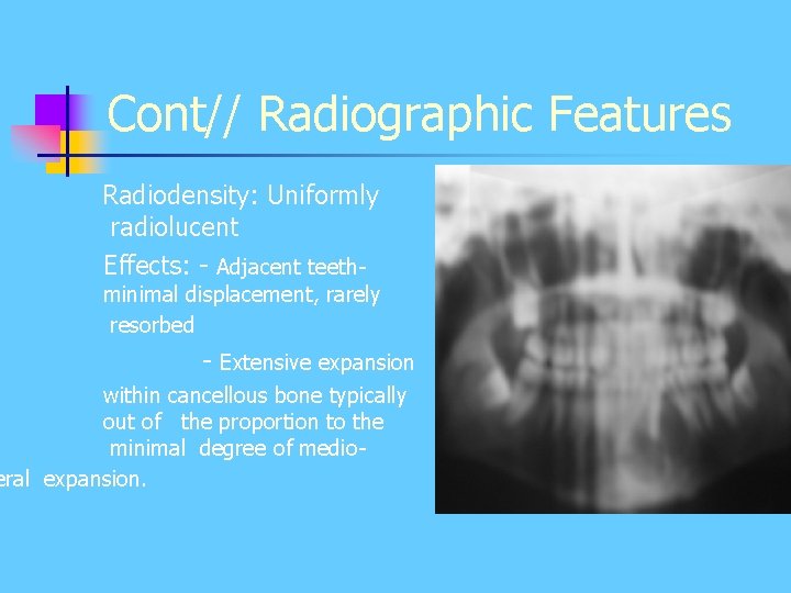 Cont// Radiographic Features Radiodensity: Uniformly radiolucent Effects: - Adjacent teeth- minimal displacement, rarely resorbed Cont// Radiographic Features Radiodensity: Uniformly radiolucent Effects: - Adjacent teeth- minimal displacement, rarely resorbed