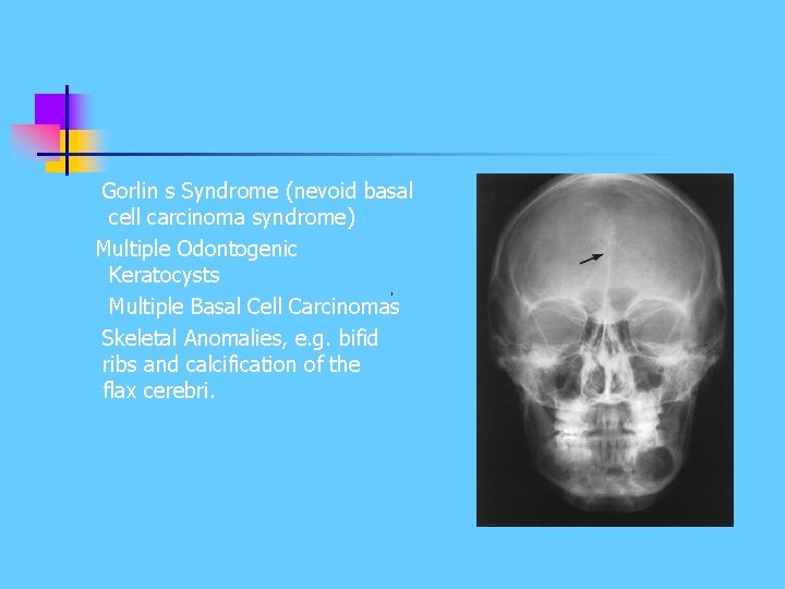 Gorlin s Syndrome (nevoid basal cell carcinoma syndrome) Multiple Odontogenic Keratocysts Multiple Basal Cell Gorlin s Syndrome (nevoid basal cell carcinoma syndrome) Multiple Odontogenic Keratocysts Multiple Basal Cell